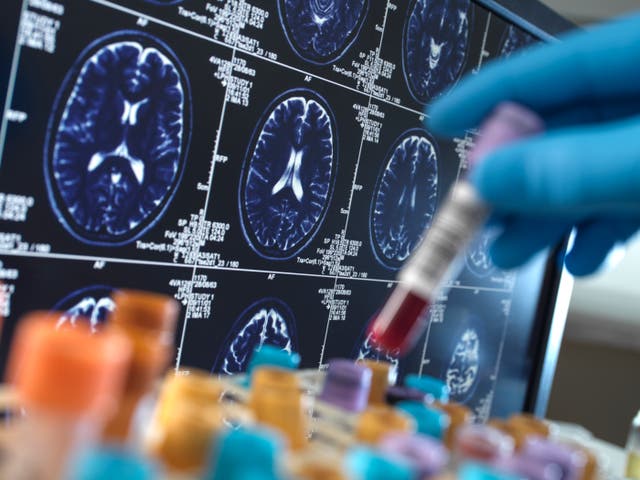 <p>England has one of the highest dementia diagnosis rates in the world</p>